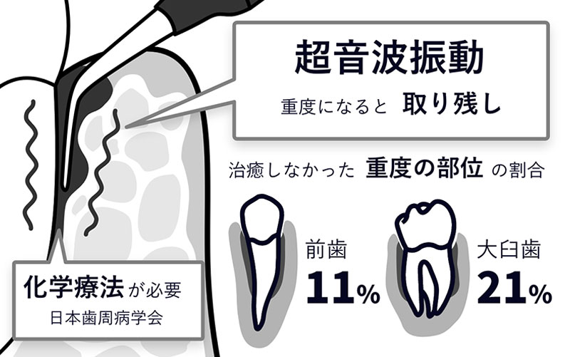 歯周病治療において、超音波振動による洗浄では重度になると取り残しが発生しやすく、前歯では11%、大臼歯では21%の割合で重度の部位が治癒しなかったという統計が示されている。化学療法の必要性が日本歯周病学会により示唆されている。