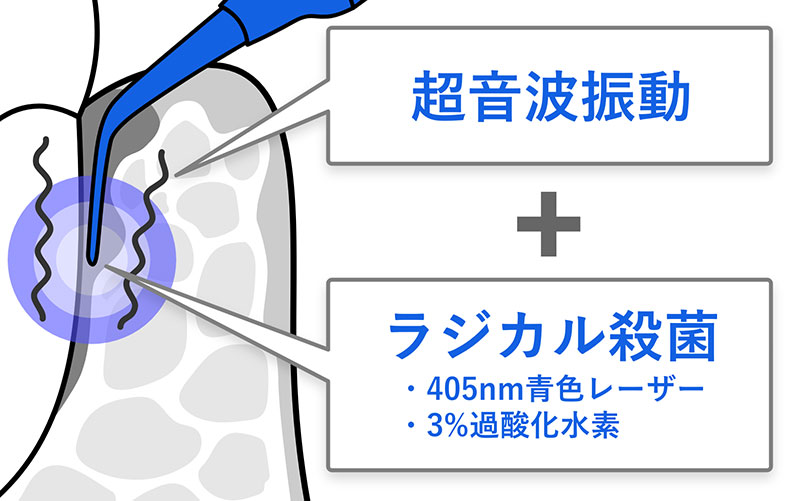 歯周病治療で、超音波振動に加え、405nm青色レーザーと3%過酸化水素によるラジカル殺菌を併用している様子を示す図。